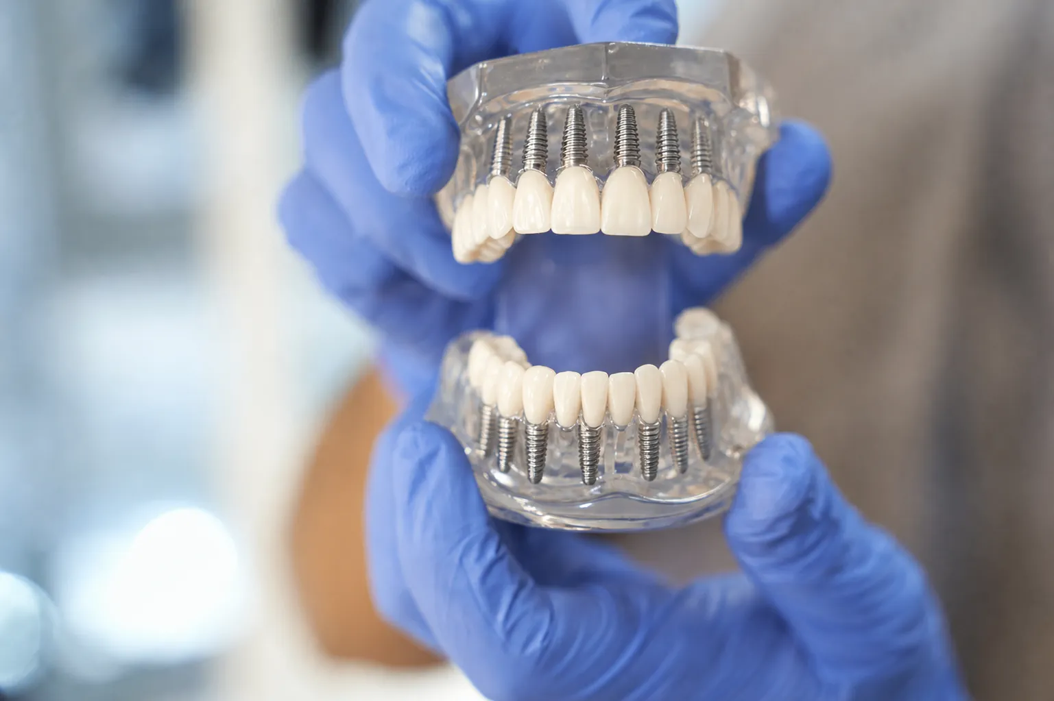 Full-arch implant models held in gloved hands