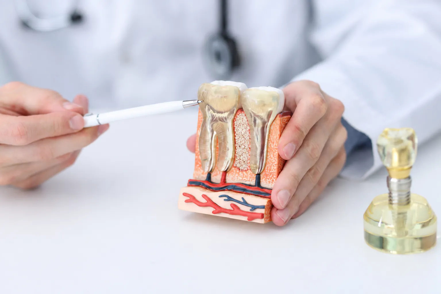 A model showing an implant and the bone around it