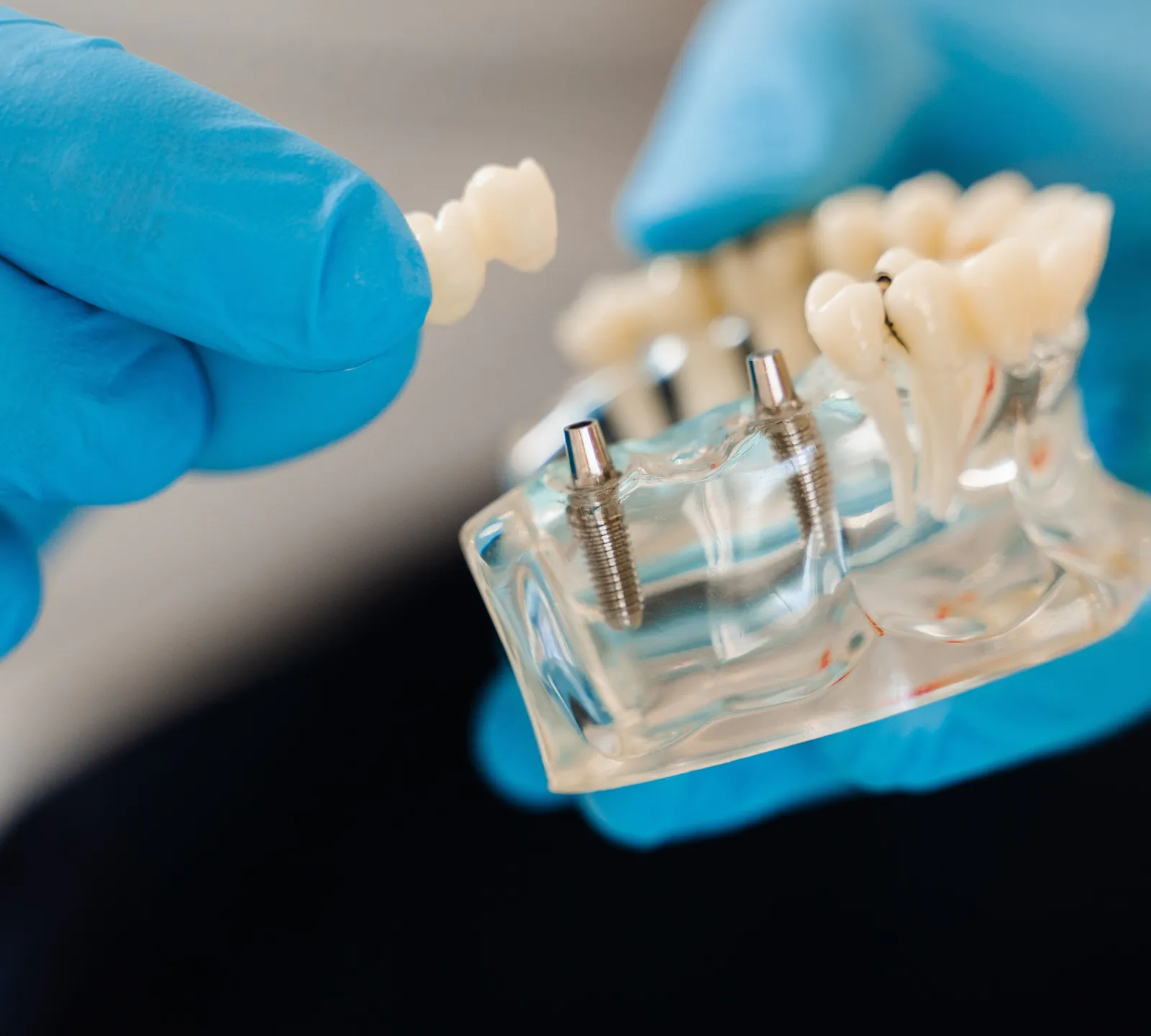 A dental bridge on a model held in gloved hands