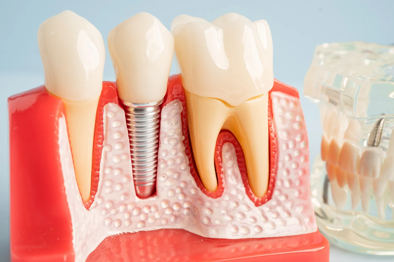 A model of a dental implant between natural teeth