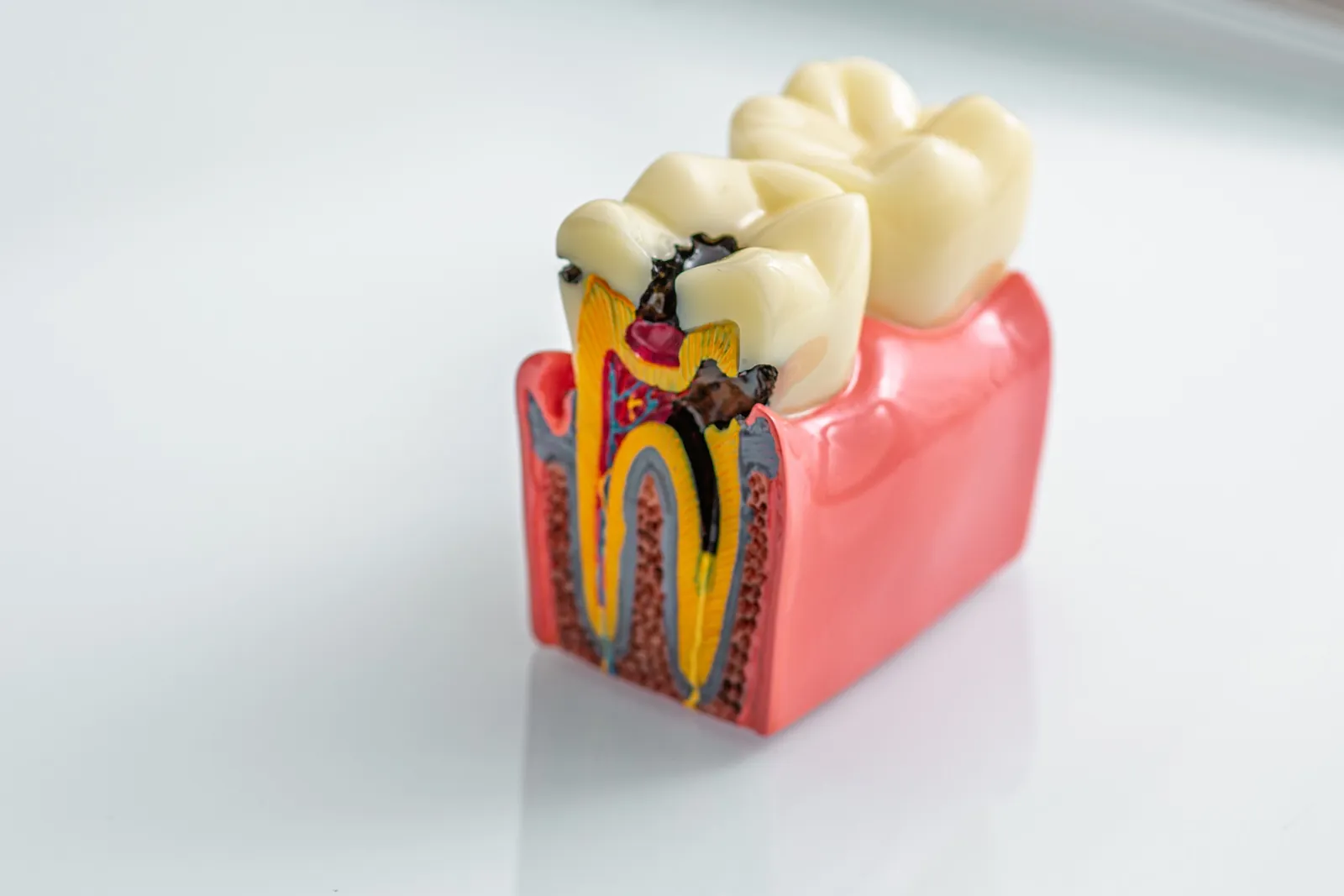A cutaway model of a tooth showing the root canal