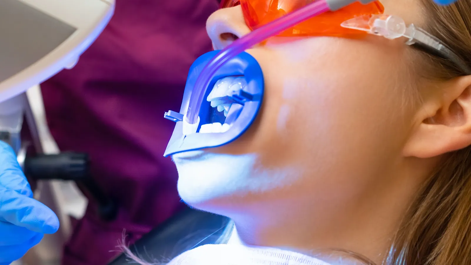 An in-office whitening treatment under a curing light