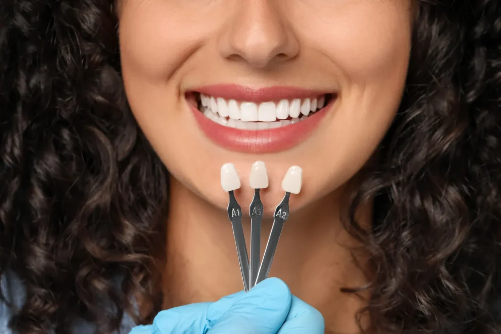 A smile beside veneer shade samples