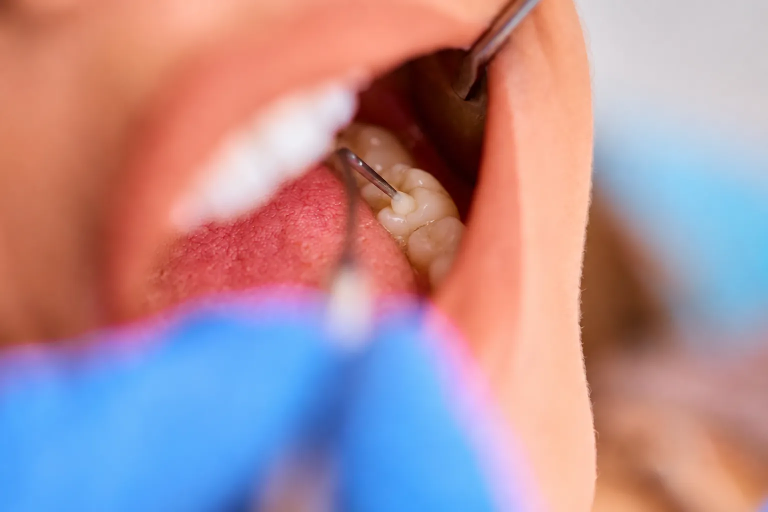 A tooth-colored filling being placed